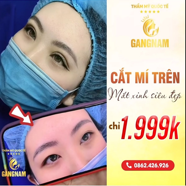 Cắt Mí Đẹp Uy Tín Tại Viện Thẩm Mỹ Quốc Tế GangNam Korea - CN Buôn Mê Thuột